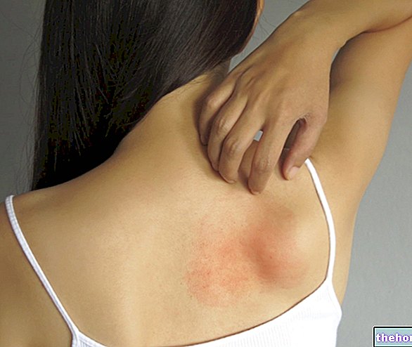 Allerginen dermatiitti - allergiat