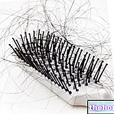 여성 남성형 탈모증 - 머리카락
