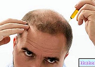 Androgenetska alopecija - dlaka
