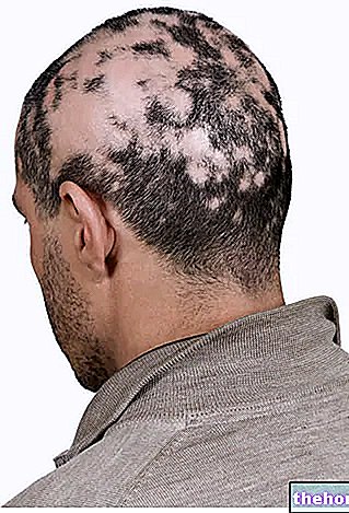 Alopeetsia Areata - juuksed