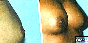 Augmentation mammaire - Chirurgie esthétique
