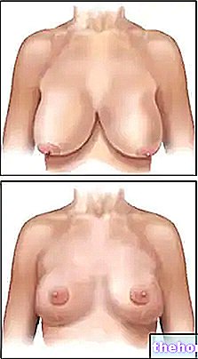 Breast reduction - Cosmetic Surgery
