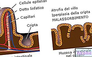 Malabsorption - food-digestion