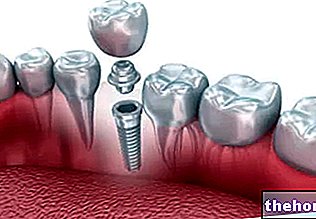 Зъбни импланти - зъбно-екстракция