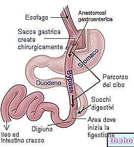Gastric bypass (Roux-en-Y gastric bypass) - kirurgiska ingrepp
