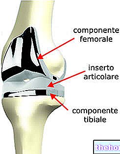 Prostesis lutut - campur tangan pembedahan