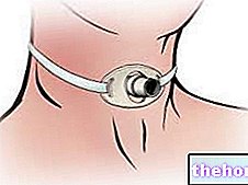 хируршке интервенције - Трахеостомија