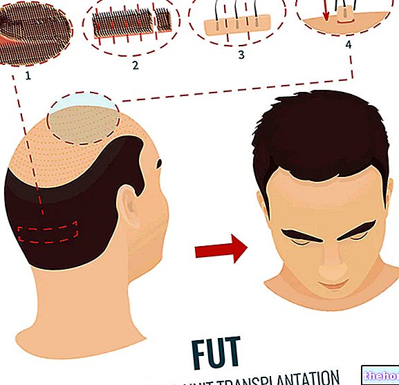 Hiusten siirto - kirurgiset toimenpiteet