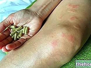 Treatments for Systemic Lupus Erythematosus: What are they? - autoimmune-diseases