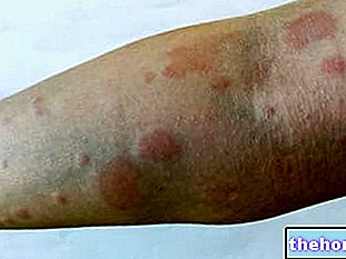 Systémový lupus erythematosus: Čo to je, príčiny a rizikové faktory - autoimunitné choroby
