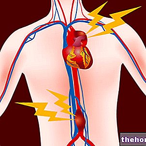 Aortna anevrizma - aortna anevrizma - bolezni srca in ožilja