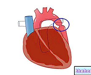 Aortna koarktacija - koarktacija aorte - bolezni srca in ožilja