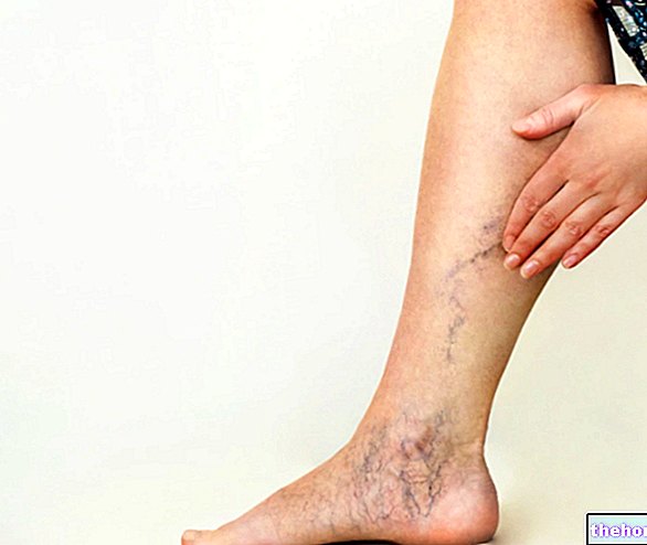 Remedies for Varicose Veins - cardiovascular diseases