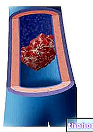 Thrombus and thrombosis - cardiovascular diseases