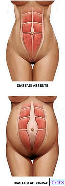 diastasis - आनुवंशिक रोग