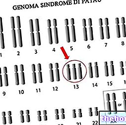 Trisomia 13: Mikä se on, syyt, oireet ja ennuste - geneettiset sairaudet
