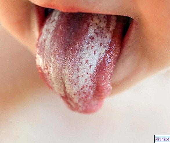 Oral Candida: Hvad er det? Årsager, symptomer og behandling