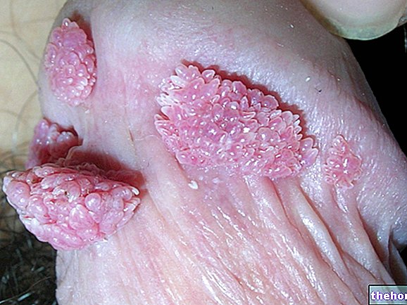 Bolesti papiloma virusa - spolno prenosive bolesti