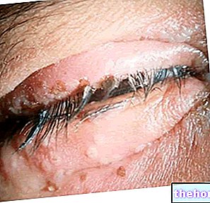 Blepharitis - kesihatan mata