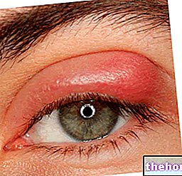 Turvonneet silmäluomet - silmien terveys