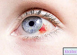 Breakage of the eye capillaries - eye-health