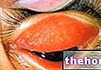 Трахома: дефиниција и симптоми - здравље очију