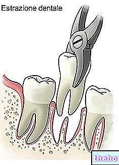 치아 건강 - 치과 발치