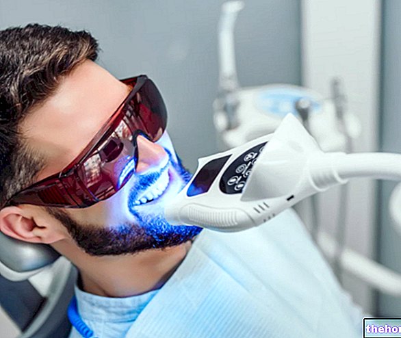 Blanchiment des dents au laser - dents-santé