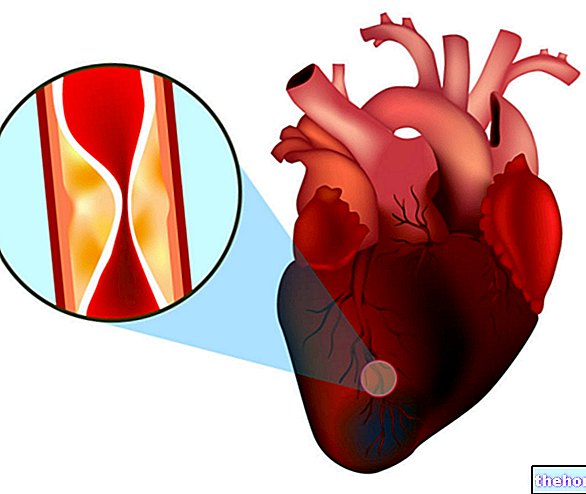 Začepljena koronarna arterija - zdravlje srca