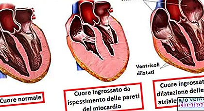 Увећано срце - кардиомегалија