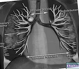 Gagal Jantung - Diagnosis dan Rawatan - kesihatan jantung