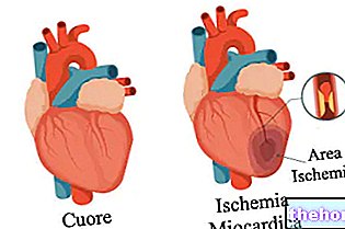 Iskemia miokardium - kesihatan jantung