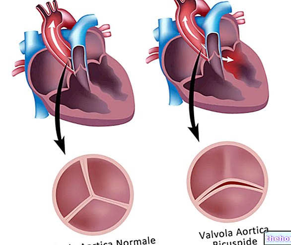 Bicuspid aortaventil: Hvad det er, symptomer og behandling