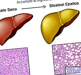 Dijeta i bolest masne jetre - masna jetra - zdravlje jetre