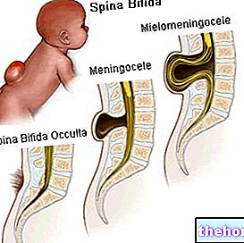 Spina Bifida - zdravje ploda