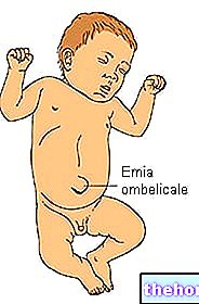 Hernie ombilicale - Symptômes et thérapie - bébé-santé