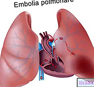 Emboli - blod-sundhed