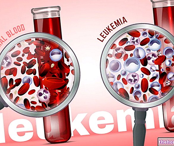 Leukeemia: üldine lähenemine haigusele - vere tervis