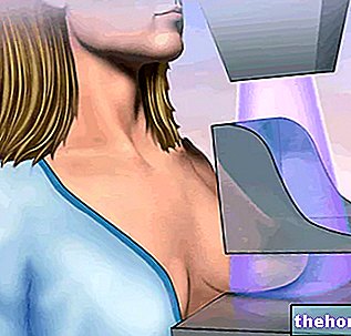 Mamografija - zdravje žensk