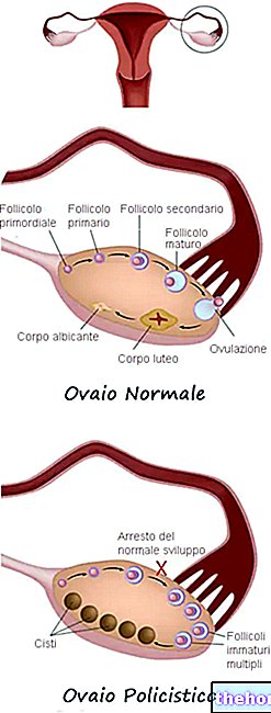 Sindrom ovari polikistik - kesihatan wanita