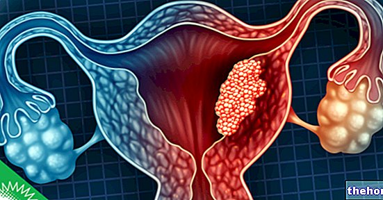 Cancer de l'endomètre : stadification et pronostic - santé des femmes