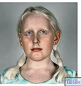 Albinismi - ihon terveys