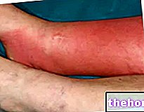 Infekční celulitida - zdraví kůže