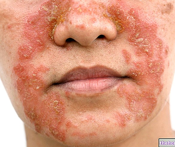 Seborröa dermatiit - naha tervis
