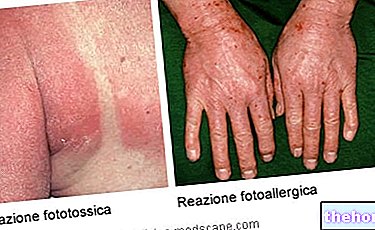 Fotosensitiviti, Fotosensitisasi dan Reaksi Photoallergic dari Dadah - kesihatan kulit