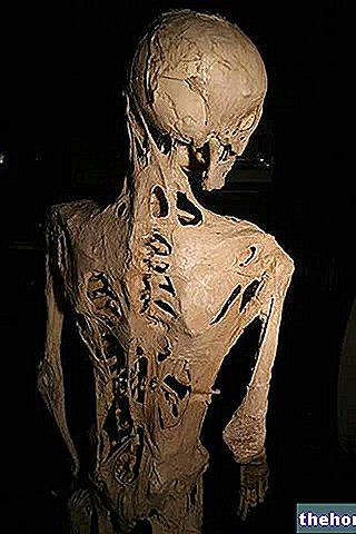 Прогресивна осифицираща фибродисплазия - здраве на костите