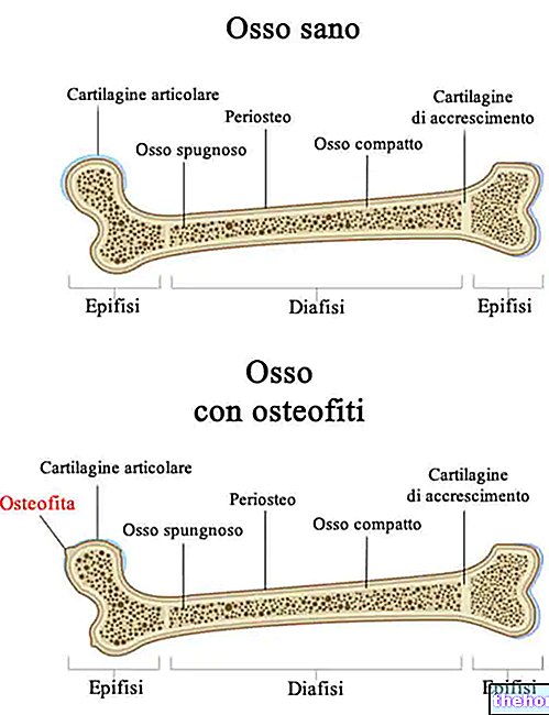 Osteophytosis - kesihatan tulang