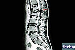 Spondylodiscitis - What is it? Causes, Symptoms, Diagnosis, Therapy and Prognosis - bone-health