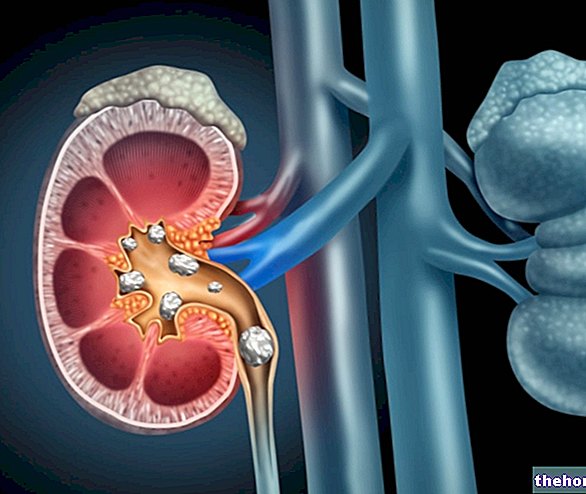 Камені в нирках: причини та фактори ризику - здоров'я сечовивідних шляхів