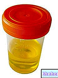 Beljakovine v urinu - proteinurija - zdravje sečil